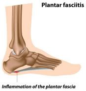 plantar fasciitis
