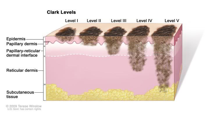 melanoma stages