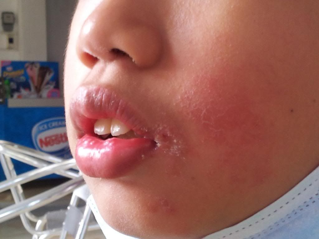 Hand, Foot and Mouth Disease