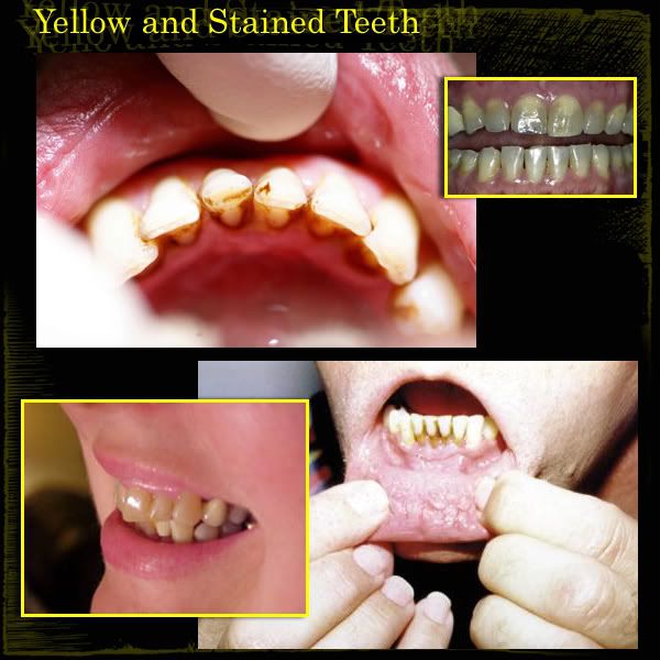 If your teeth vary in color or