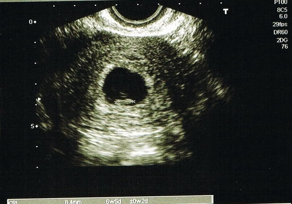 ultrasounds at 6 weeks. Ultrasound-6weeks-noname.jpg